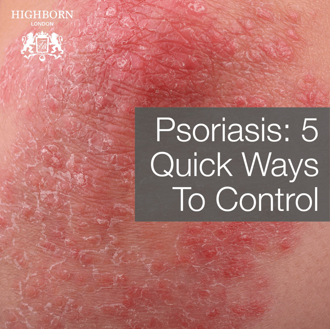 5 Quick Fixes To Avoid Psoriasis Flare-Ups